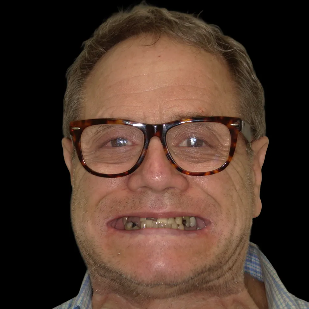 Before Advanced Implantology